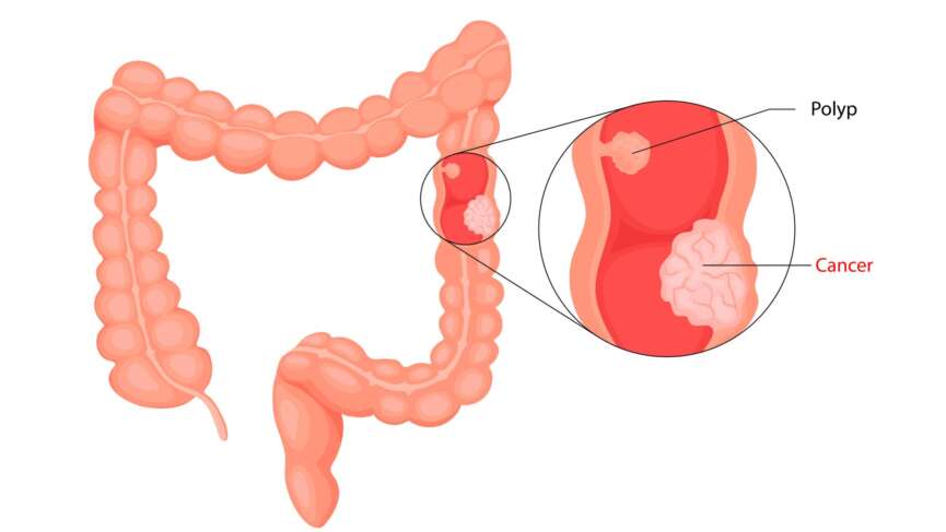 Colorectal cancer (crc) infographic for education presenting the factors affecting colon cancer