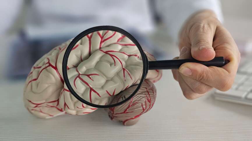 signs of mini stroke