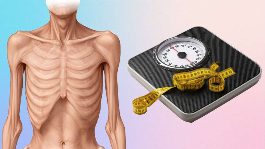 bmi and cancer cachexia