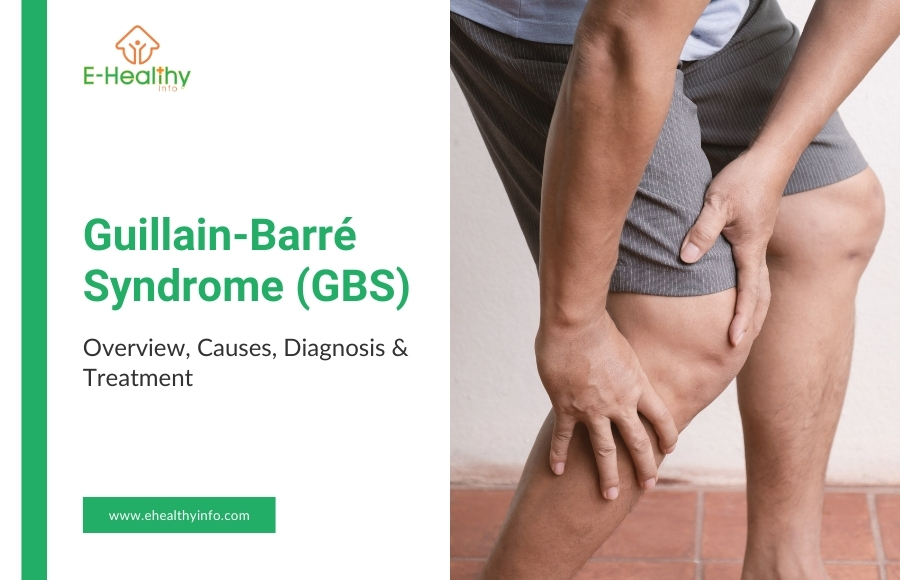 Guillain-Barré Syndrome (GBS): Causes, Symptoms, Diagnosis, Treatment, and Recovery Explained