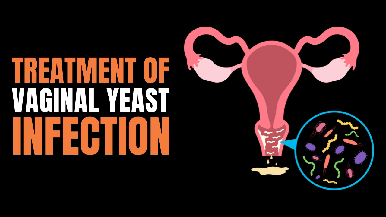 Treatment Of Vaginal Yeast Infection – Do’s & Don’ts